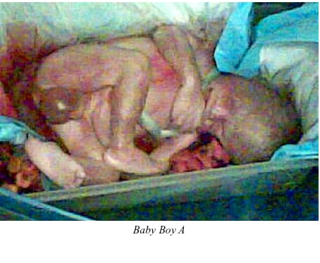 aborted baby boy